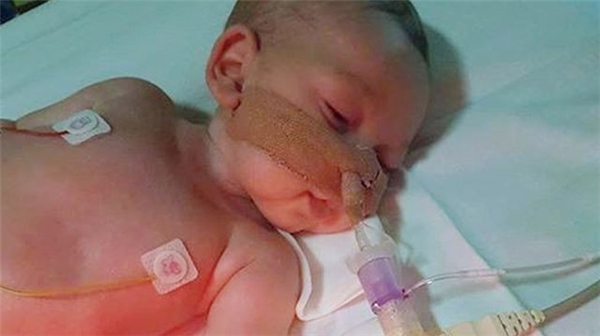 8 Aylık Bebek Charlie, Mahkeme Kararıyla Yaşam Destek Ünitesinden Çekilecek